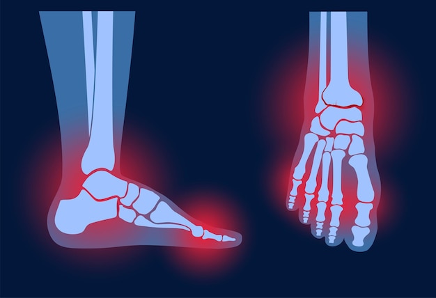 Вектор Артрит стопы сустава. ревматоидная боль в ноге плоская векторная иллюстрация
