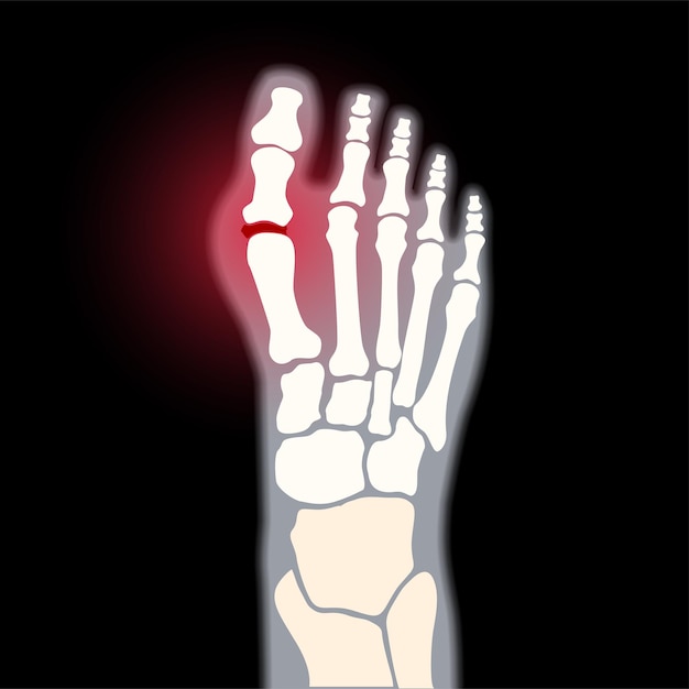 Vector arthritis foot joint. rheumatoid pain in leg  flat vector illustration