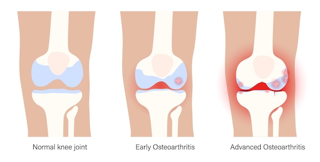 관절염 무릎 관절 배너입니다. 류마티스 관절염 클리닉 로고. 다리에 통증이 있습니다. 인간의 뼈 해부학