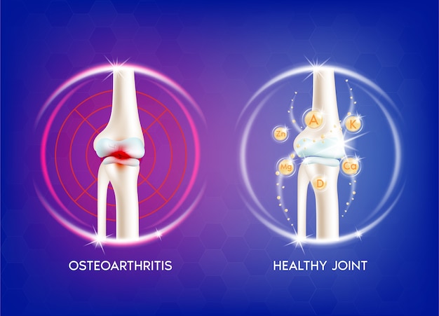 벡터 관절염 무릎 관절. 인간의 뼈 해부학. 골격 x 레이 스캔 개념 및 비타민 요법.