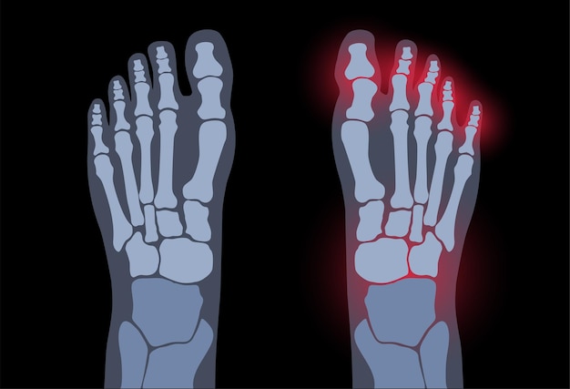 Artritis voetgewricht. reumatoïde pijn in been platte vectorillustratie