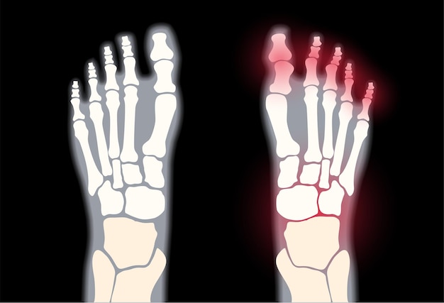 Vector artritis voetgewricht. reumatoïde pijn in been platte vectorillustratie