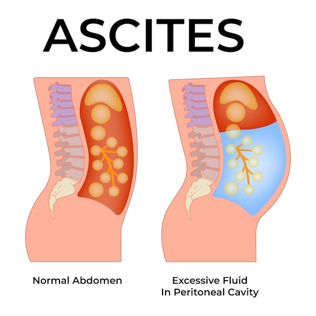 Vector ascites normal abdomen excessive fluid in peritoneal cavity vector illustration