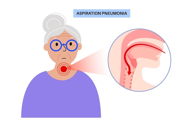 Aspiration pneumonia poster