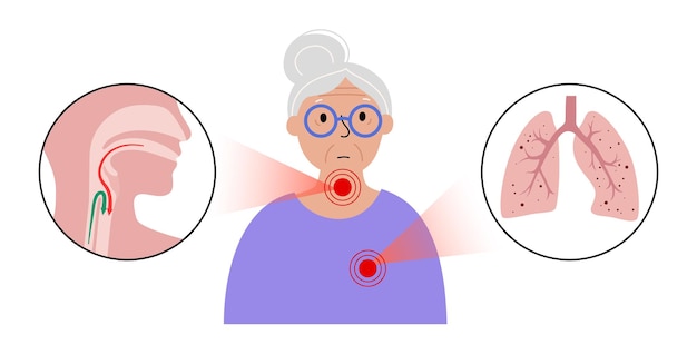 Aspiration pneumonia poster