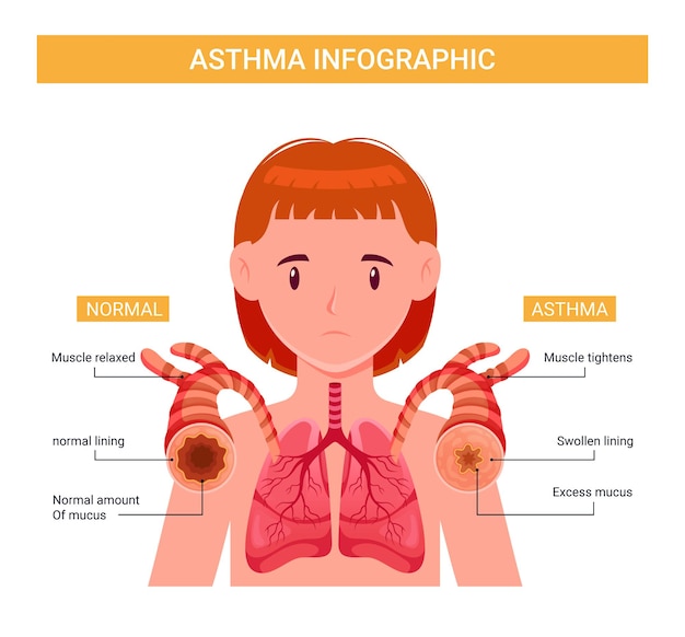 Asthma infographic, concept human asthma, healthy and unhealthy lung illustration