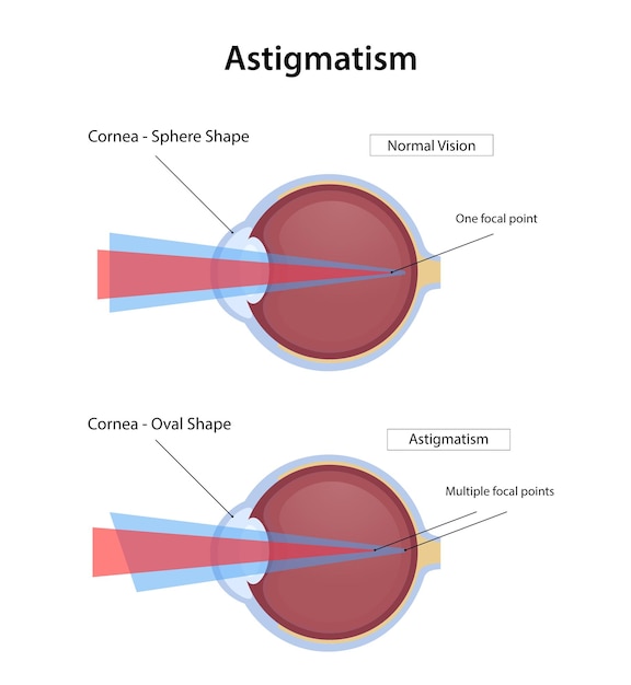 Malattia dell'astigmatismo, visione normale e disegno dell'illustrazione dell'astigmatismo