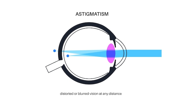 Vector astigmatism eye disease