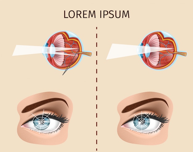 Astigmatism vector diagram