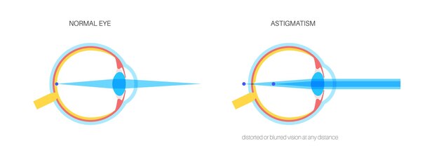 Vector astigmatisme oogziekte