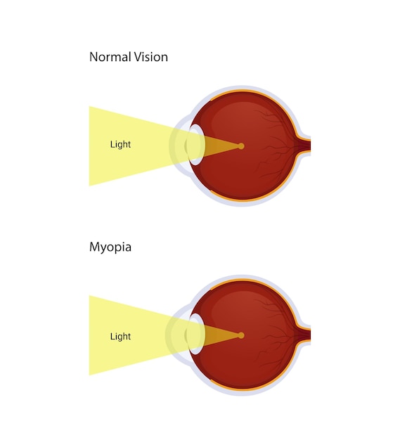 Vector astigmatismeziekte, vectorillustratieontwerp voor medisch