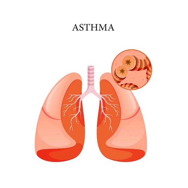 Astmaziekte, astma vectorillustratie