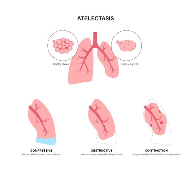 Atelectase medische poster