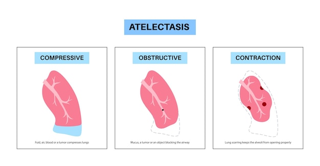 Vettore manifesto medico dell'atelettasia