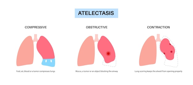 Manifesto medico dell'atelettasia