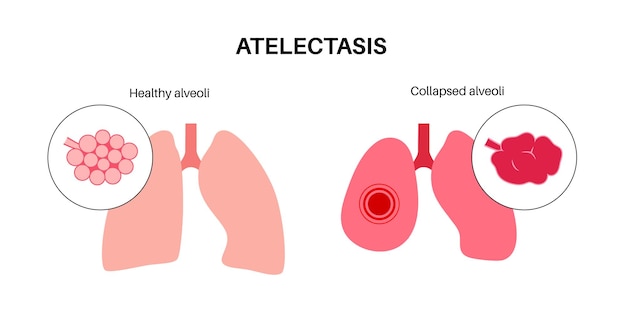 Медицинский плакат ателектаза