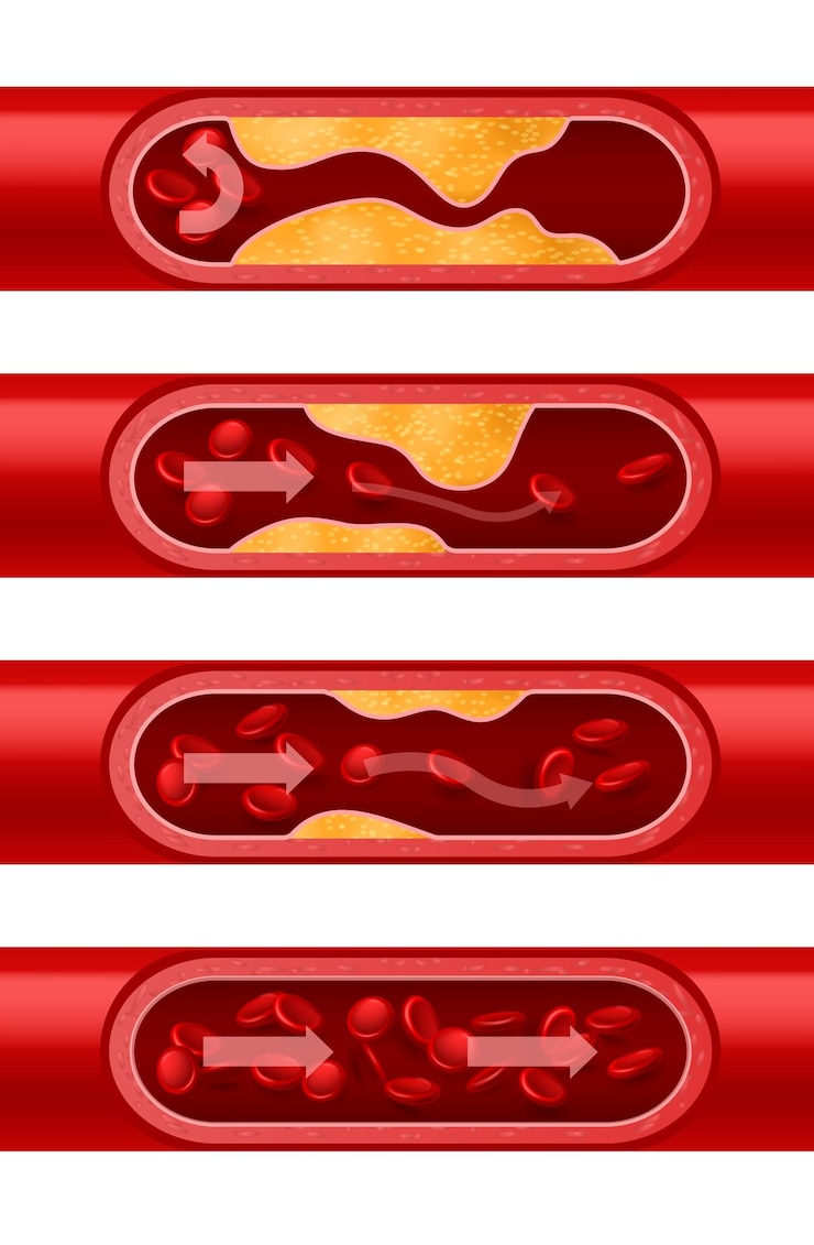 Vector atherosclerose slagader stapsgewijze cholesterol afzetting arteriële wanden bloedvat sectie set erytrocyten stroom bloedige cellen stroom vector ontwikkeling van hart- en vaatziekten