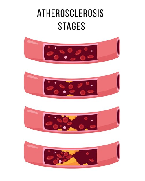 Atherosclerosis stages isolated on white