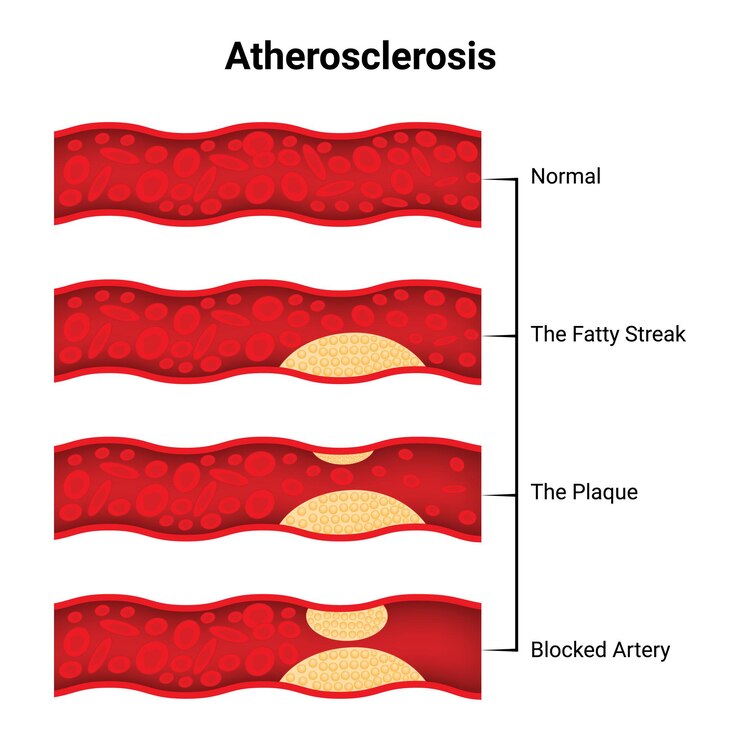 Vector atherosclerosis stageshealthy and atherosclerosis vessels with blood cells vector illustration
