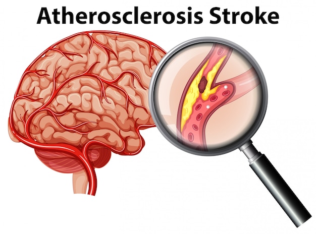 Atherosclerosis stroke on white background