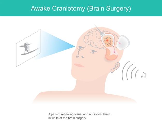 Awake craniotomy A patient receiving visual and audio test brain in while at brain surgeryxA