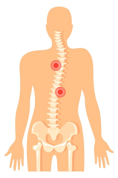 Vettore dolore alla spina dorsale icona del dolore alla colonna vertebrale diagramma della colonna vertebrale