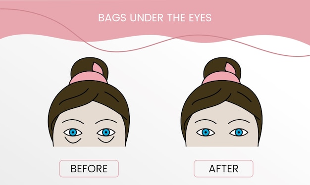 Bags under the eyes laser cosmetology before procedure and after applying treatment in vector Illustration of a woman with smooth clean skin and problematic skin