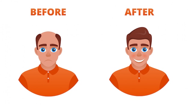 Vector bald man after hair transplant. the result of the use of minoxidil. wearing a wig