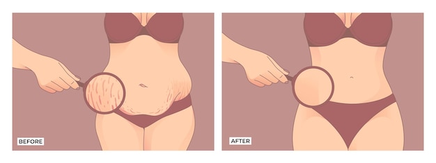 Vector belly fat. before and after weight loss, woman body shape transformation, fat to fit.