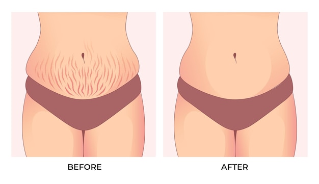 belly fat. before and after weight loss, woman body shape transformation, fat to fit.