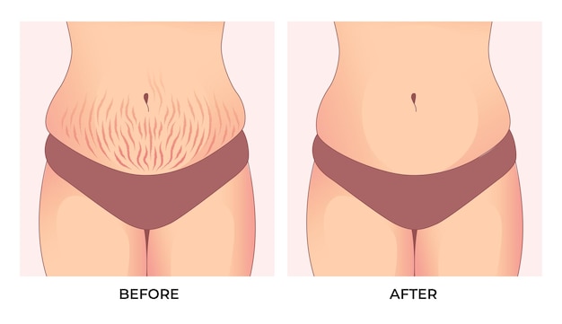 Belly fat. Before and after weight loss, woman body shape transformation, Fat To Fit.