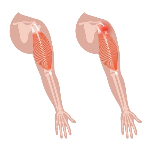 Vector biceps tear trauma