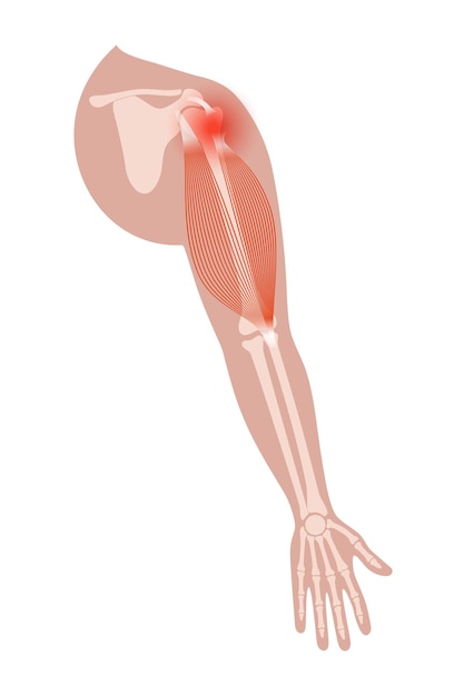 Vector biceps tear trauma