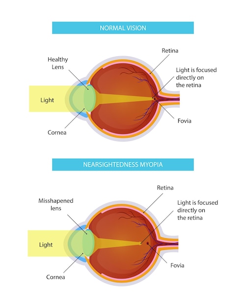 Bijziendheid ziekte vector infographic, ontwerp illustratie voor medisch