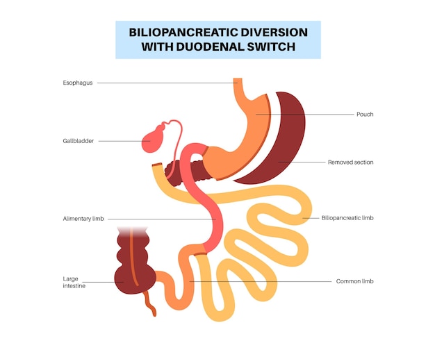 십이지장 스위치 Bpd 위 수술 개념 체중 감소 위 절차 복부 복강경 검사 과체중 및 비만 인체 평면 벡터 의료 그림으로 Biliopancreatic 전환