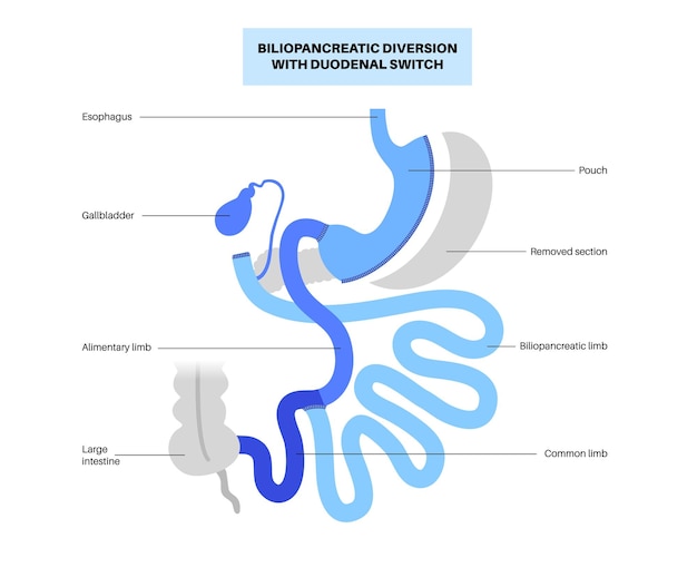 Biliopancreatic diversion with duodenal switch BPD stomach surgery concept weight loss gastric procedure Abdomen laparoscopy Overweight and obesity in human body flat vector medical illustration