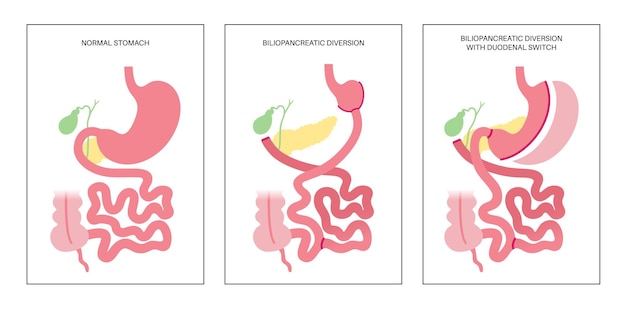 Deviazione biliopancreatica con interruttore duodenale bpd chirurgia dello stomaco perdita di peso procedura gastrica organi interni prima e dopo l'operazione problema di sovrappeso e obesità illustrazione vettoriale piatta