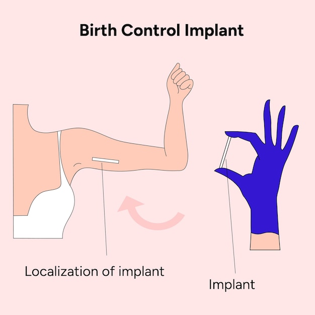 Birth control implant illustration in vector