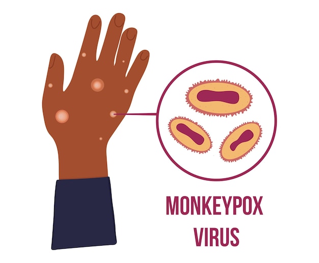 Black african hand with many papule because of monkey pox virus outbreak pandemic