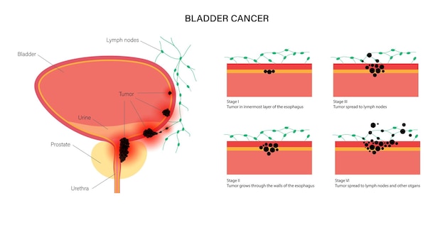 Vettore stadi del cancro alla vescica