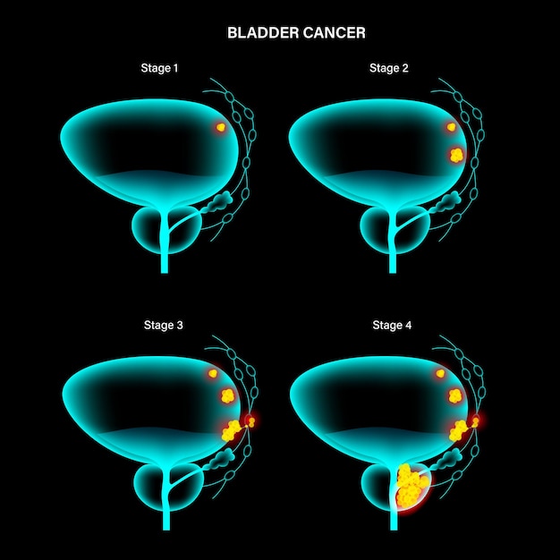 Vector bladder cancer stages