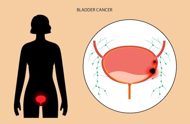 Bladder cancer stages