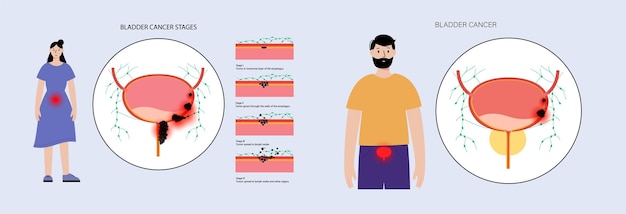 Bladder cancer stages