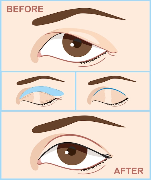 Blepharoplasty of eyelid, before and after, infographics with icons of plastic surgery procedures