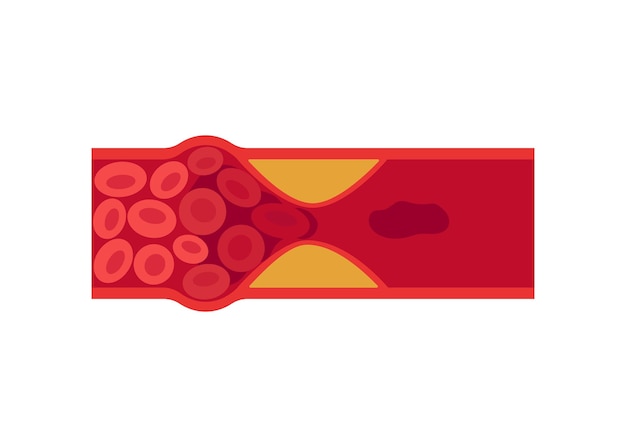 Bloedstolsel trombus in ader of slagader ader trombose slagader stolsel slagader ader cholesterol ziek