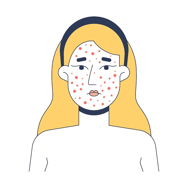 Blonde woman acne breakout skin problem 2D vector illustration