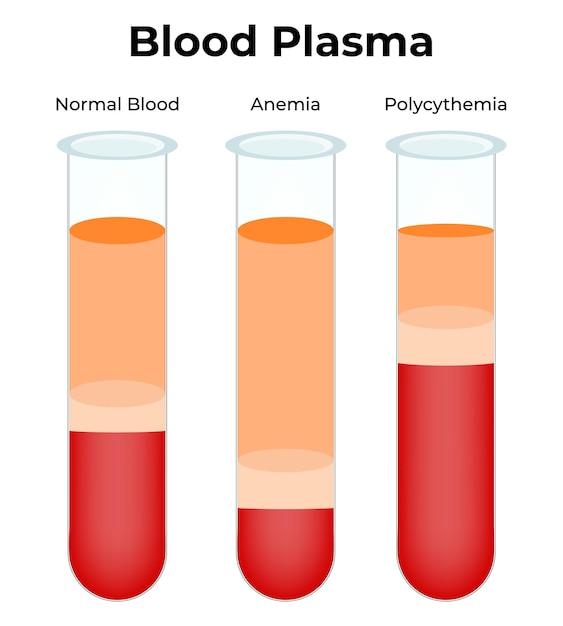 벡터 혈액 플라즈마 정상 혈액 빈혈 폴리시테미아 터 일러스트레이션