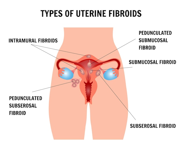 Vettore corpo con infografica sui tipi di fibromi uterini nell'illustrazione vettoriale