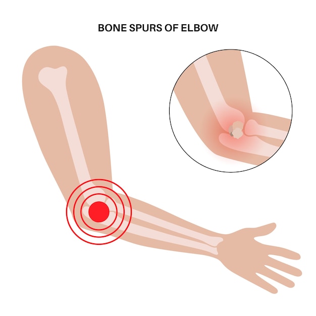 bone spur removement elbow joint minimally invasive surgery arthroscopy medical procedure anatomy of humerus ulna and radius bones arm pain swollen and inflammation x ray illustration
