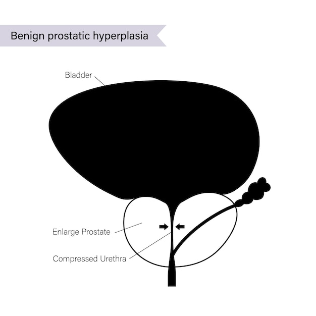 BPH info concept